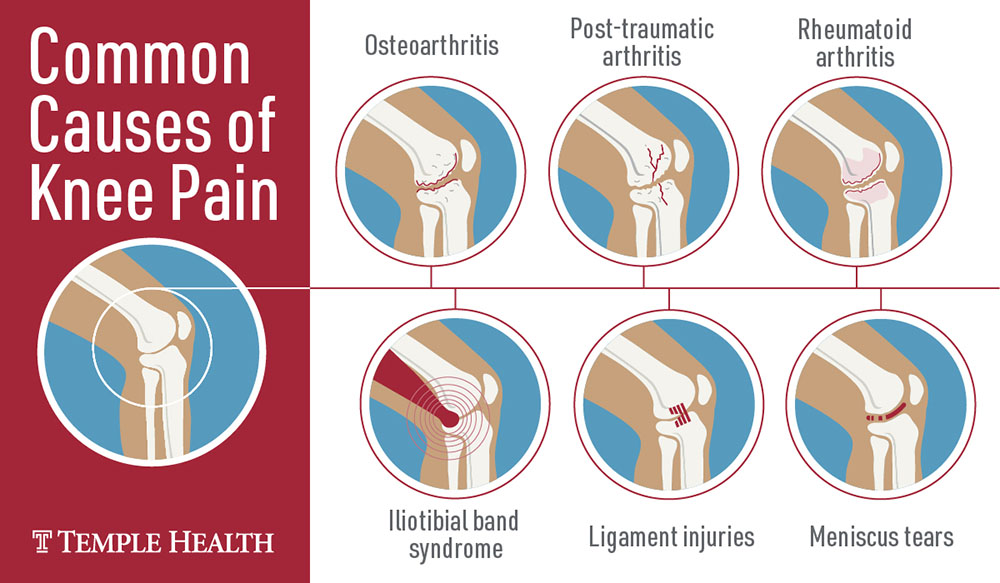 Common Causes Of Knee Pain Infographic 