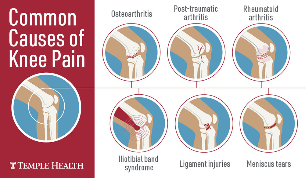 Do I Need Surgery If My Knee Hurts Temple Health