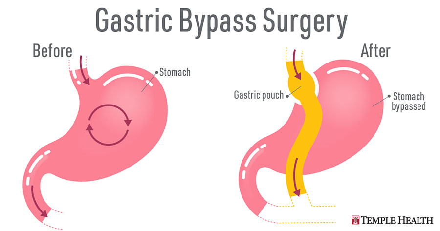 roux en y gastric bypass before after