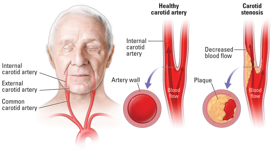 Carotid Stenosis Temple Health