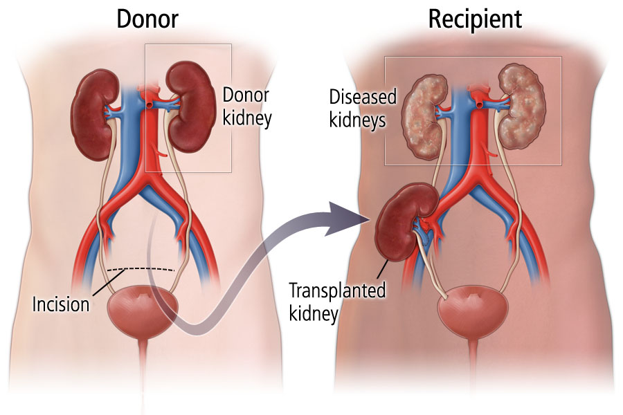 Living Kidney Donor Program Temple Health