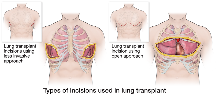 lung transplant scar