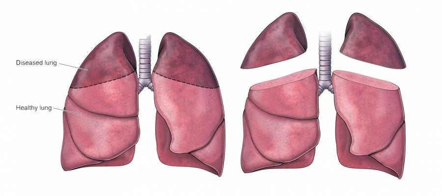 Lung Volume Reduction Surgery (LVRS) | Temple Health