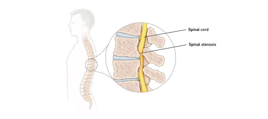 Lumbar Stenosis: Causes, Symptoms and Treatment Options for