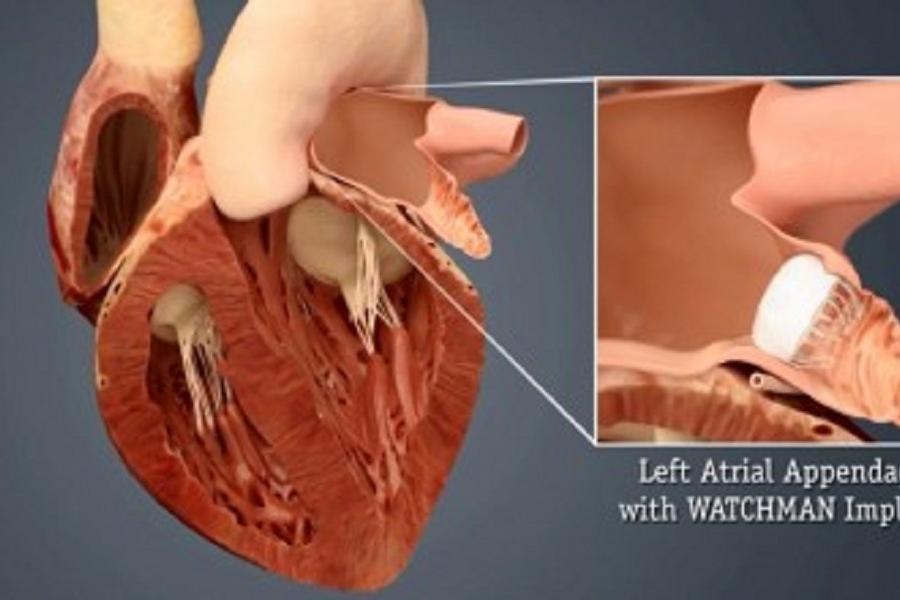 Left Atrial Appendage (Watchman™ Device) | Temple Health