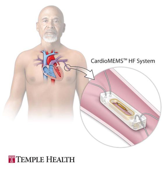 pulmonary artery monitoring