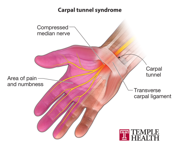 carpal tunnel numb hand