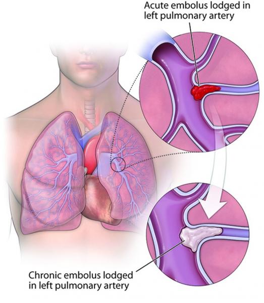 Pulmonary pressure deals