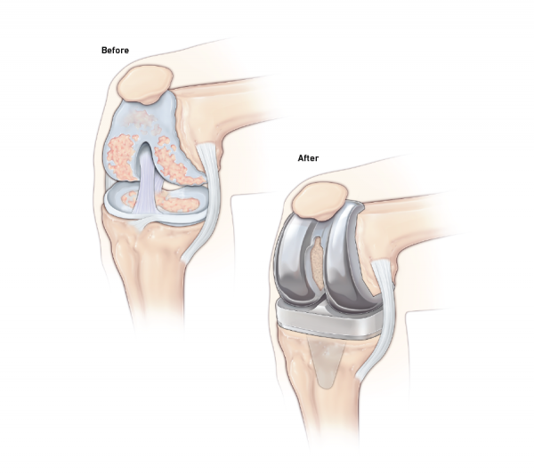 Total Knee Replacement Surgery Recovery