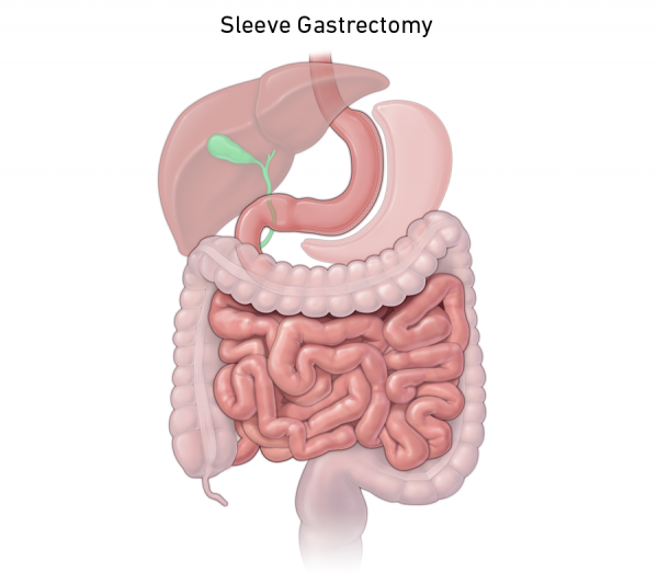 Gastric Sleeve | Bariatric Program | Temple Health